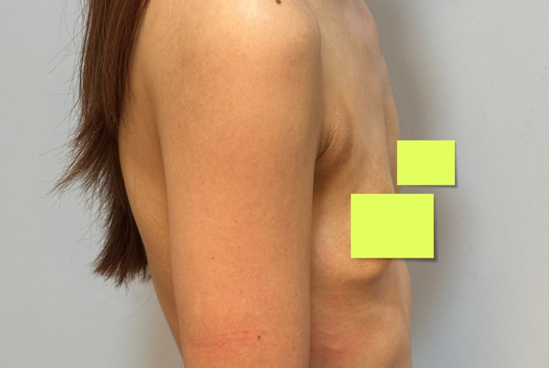 before photo: 가슴(보형물)