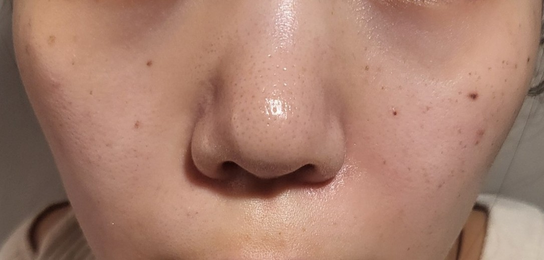 after photo: IPL(光/フォト治療), 診断・検査