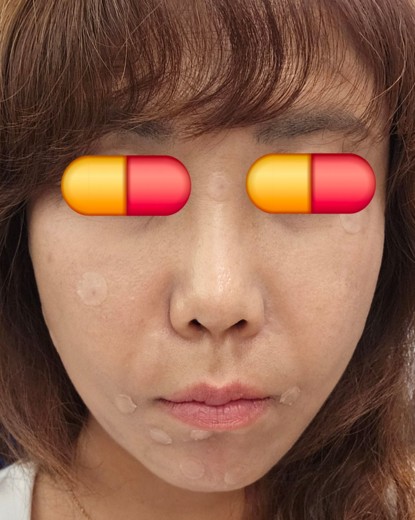 after photo: 점제거시술, V레이저