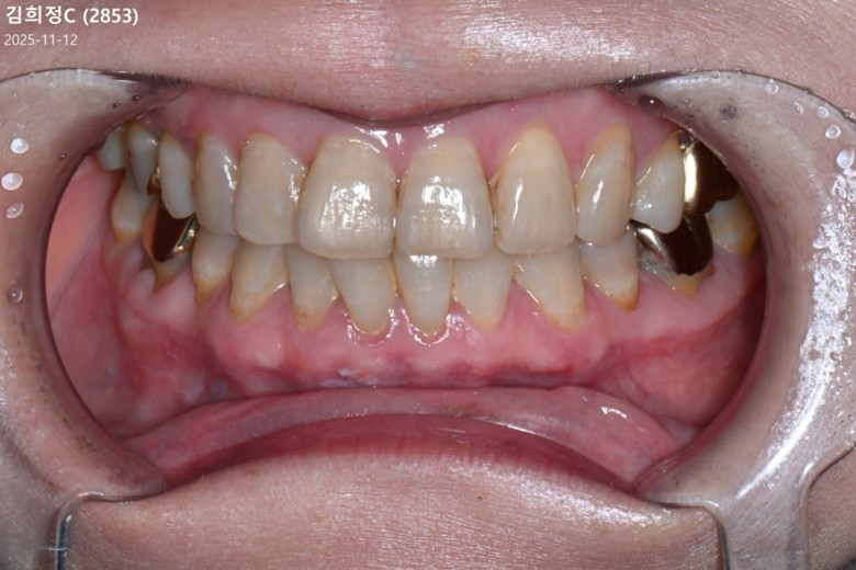 before photo: 치아미백