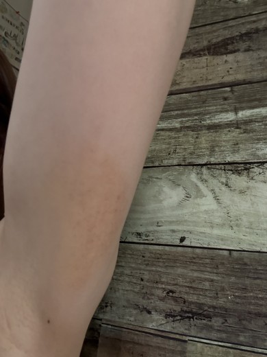 after photo: 脂肪冷却(腕)