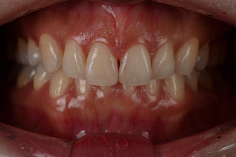 before photo: 라미네이트