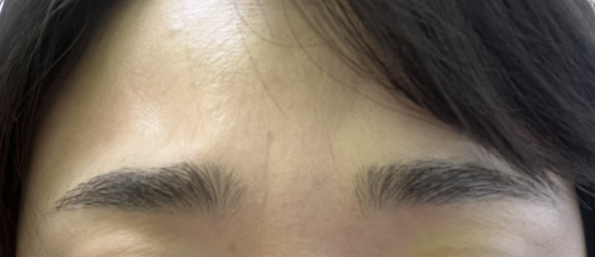 before photo: 사각턱보톡스