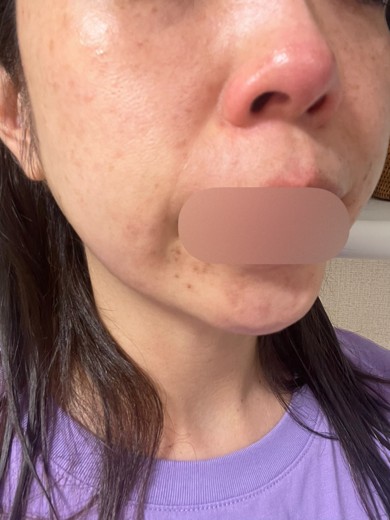 after photo: フラクショナルレーザー, エレクトロポレーション