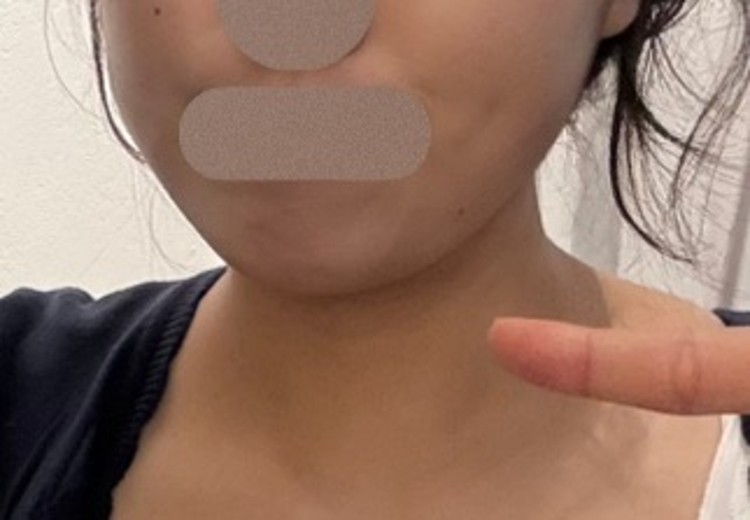 after photo: 윤곽주사, 얼굴지방분해주사