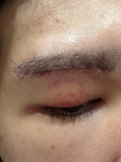 after photo: 眼瞼下垂(目つき矯正)