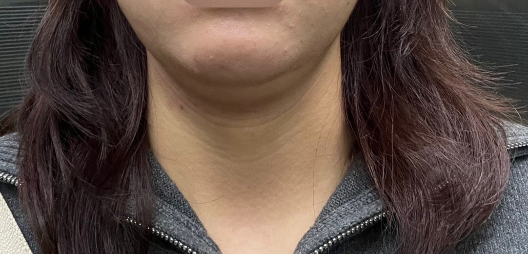 before photo: 윤곽주사