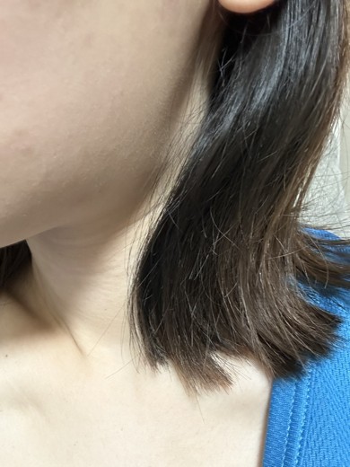 after photo: 脂肪溶解注射(顔)