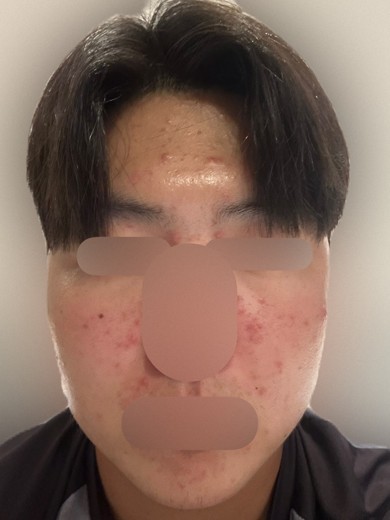 before photo: PRP피부재생술