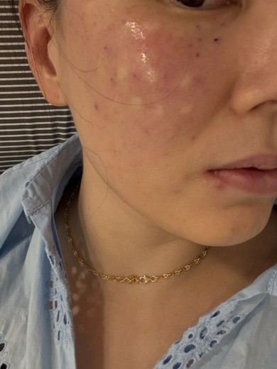 after photo: 스킨보톡스