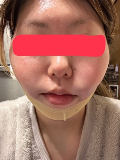 after photo: 糸リフト, 脂肪吸引(顎下), 脂肪吸引(顔), 脂肪吸引(頬)