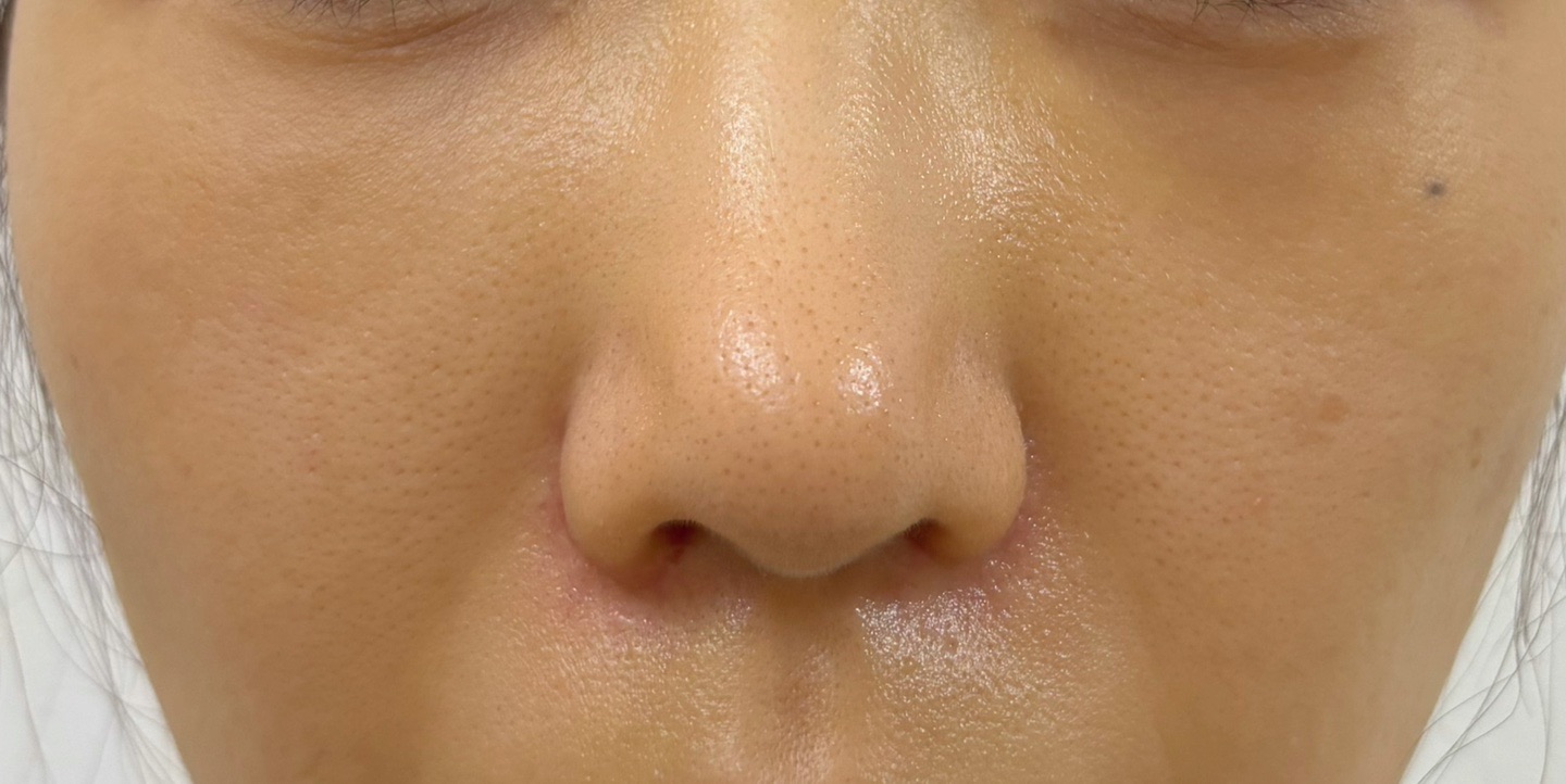 鼻尖形成 or 小鼻縮小（内側、外側） | 表参道ウィズ・クリニック