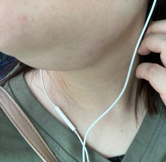 after photo: 脂肪溶解注射(顔)