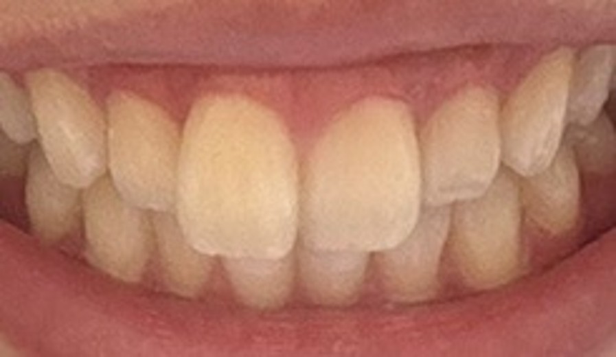 after photo: ホワイトニング