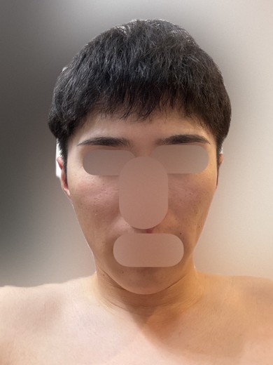 after photo: IPL(光/フォト治療)