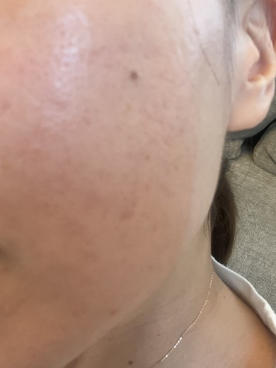 after photo: IPL(光/フォト治療)