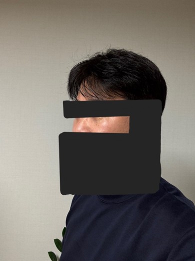 after photo: 눈밑지방재배치