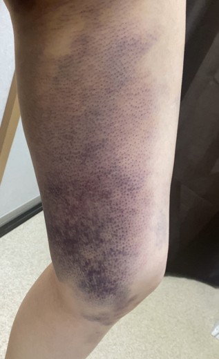 after photo: 豊胸(脂肪注入)