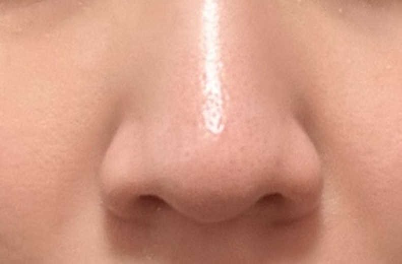 before photo: 脂肪溶解注射(顔)