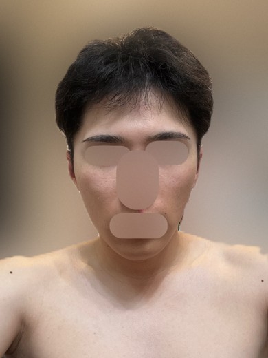 after photo: IPL(光/フォト治療)