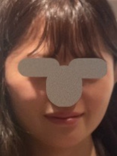 before photo: ウルトラセルQ+(ハイフ)