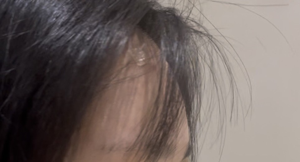 after photo: 이마필러