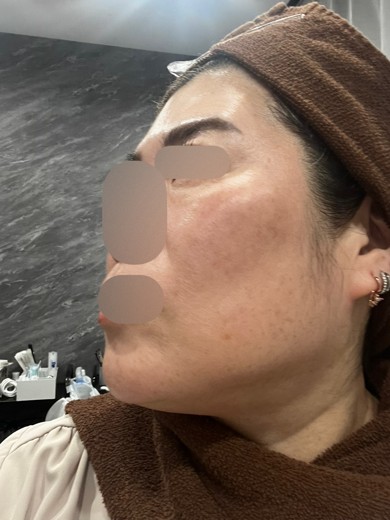 before photo: ヴェルベットスキン