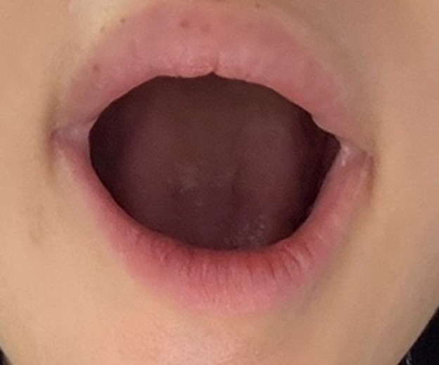 after photo: 실리프팅