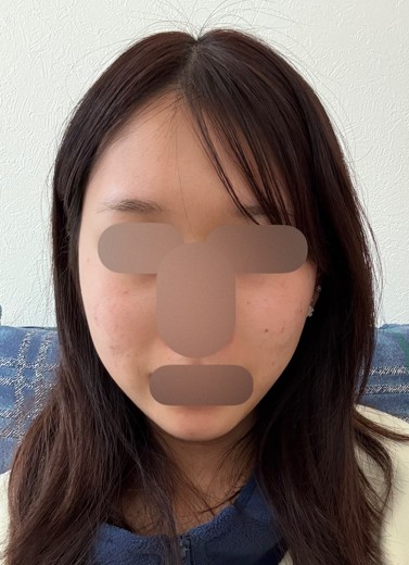 after photo: ヒーライト