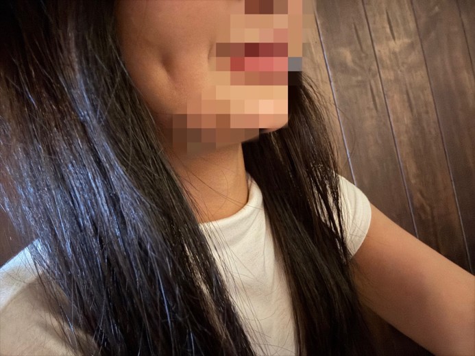 after photo: 보조개성형