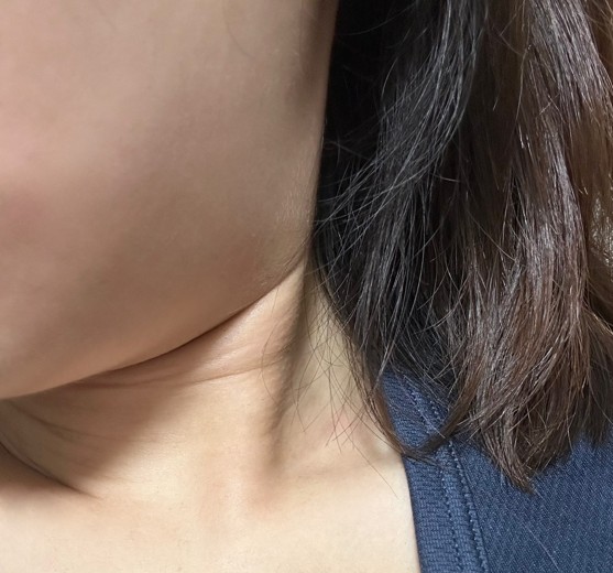 after photo: 脂肪溶解注射(顔)
