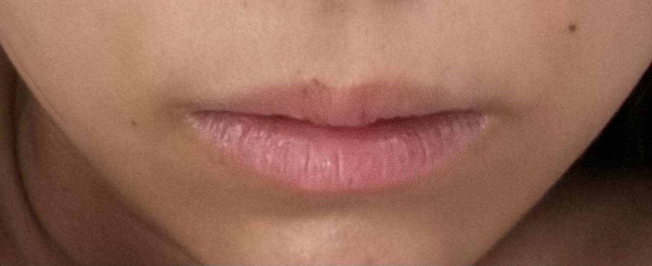after photo: 口角ボトックス