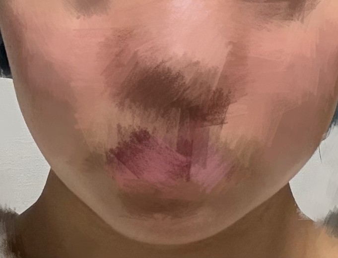 after photo: 脂肪溶解注射(顔)