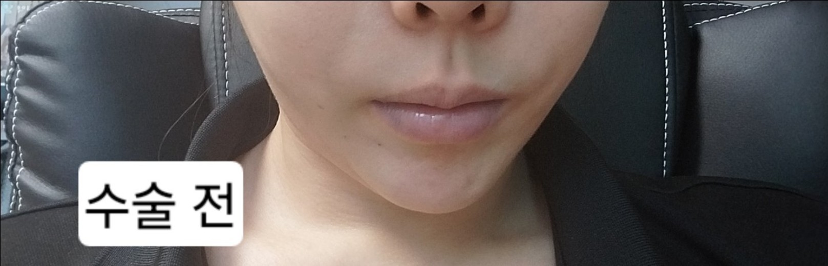 before photo: 턱끝보형물제거