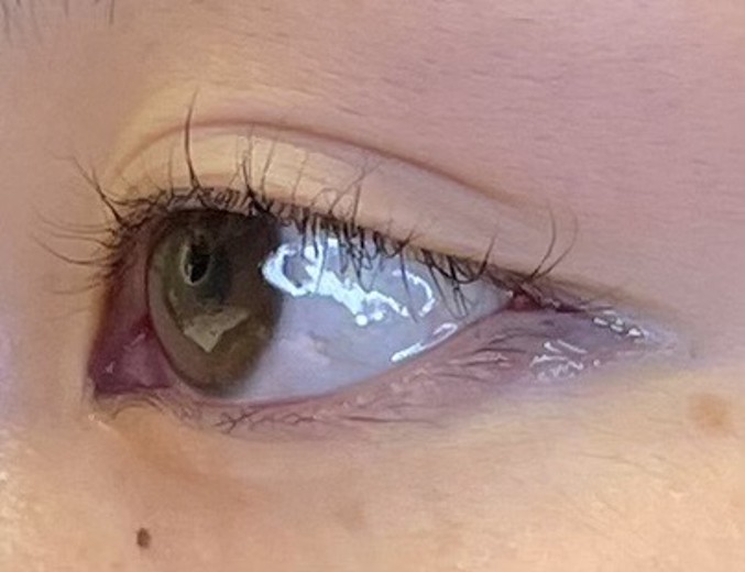 after photo: 目尻切開