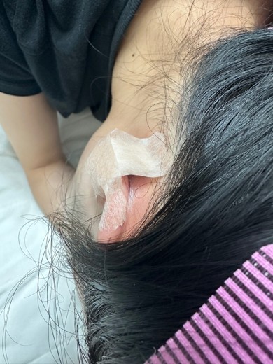 after photo: 캘로이드귀성형