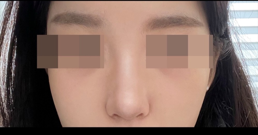 after photo: 콧볼축소