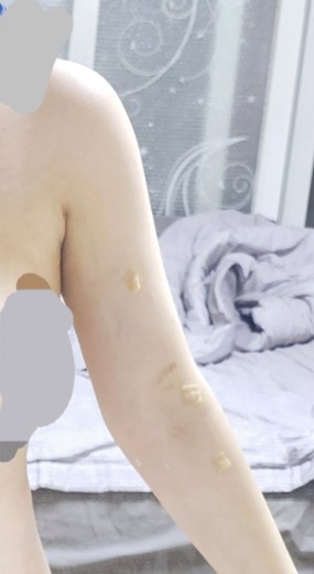 after photo: 러브핸들지방흡입, 복부지방흡입