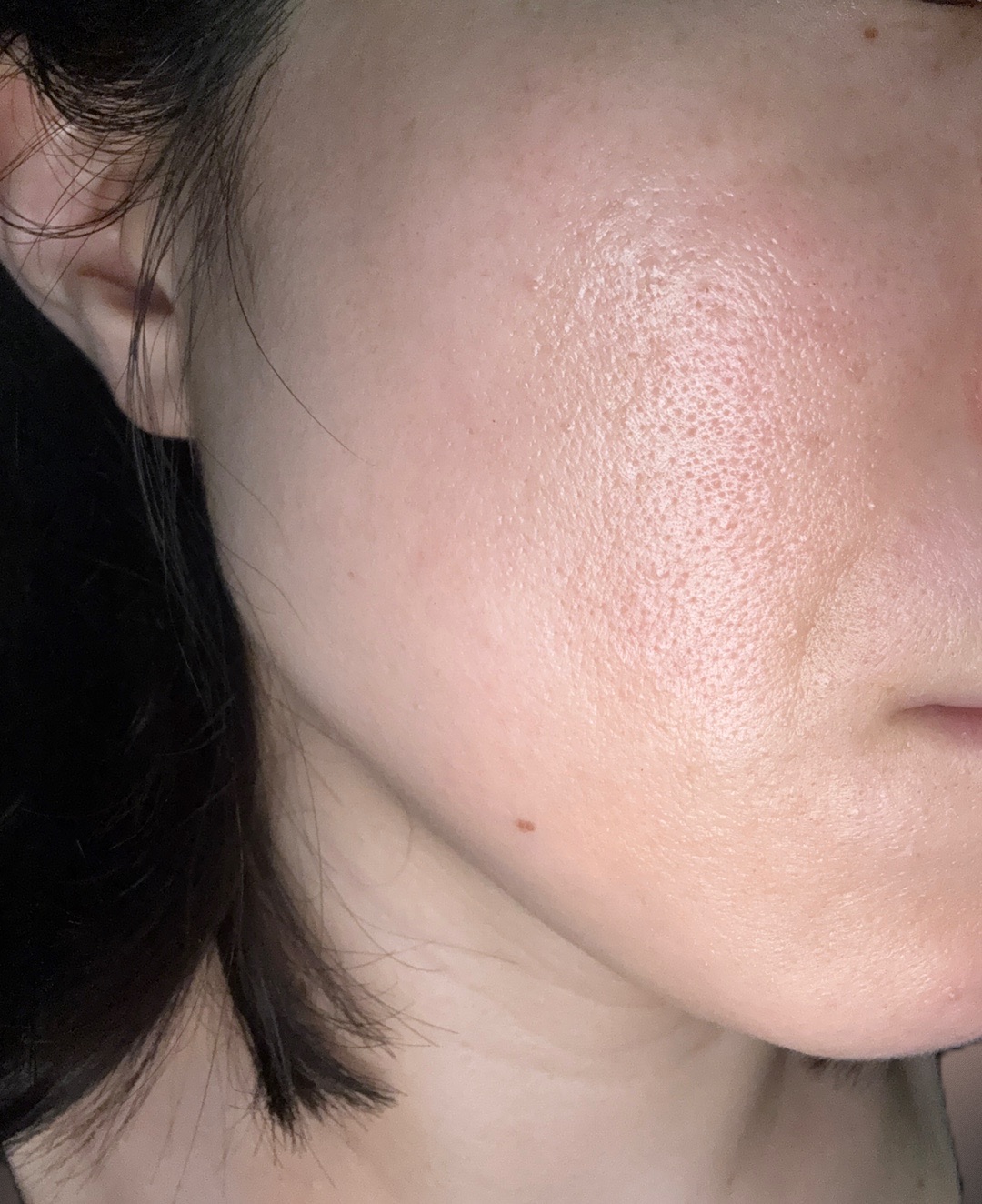 初診限定】ララピール（全顔）＋エレクトロポレーション