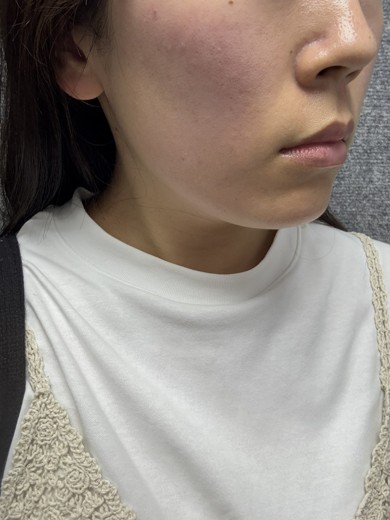 after photo: インモード