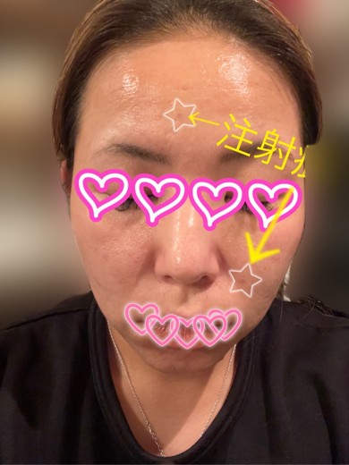 after photo: インモード, ジュベルック(Juvelook)