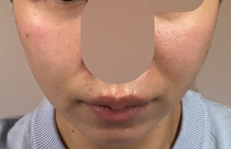 after photo: サーモン注射