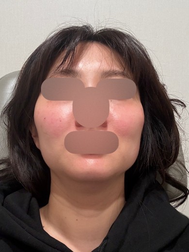 after photo: 얼굴지방분해주사