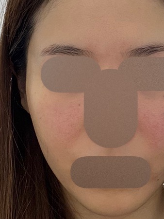 ジェネシス＋エレクトロポレーション【再来OK】 | ライズワン美容皮膚