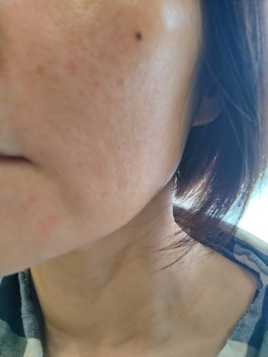 after photo: ピコトーニング