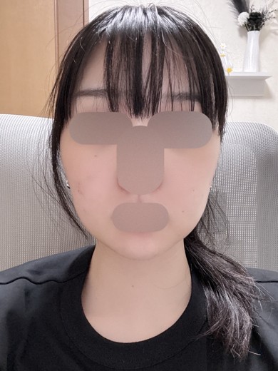 after photo: 脂肪溶解注射(顔)