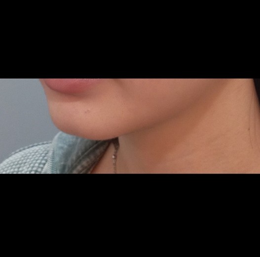 before photo: 턱끝필러