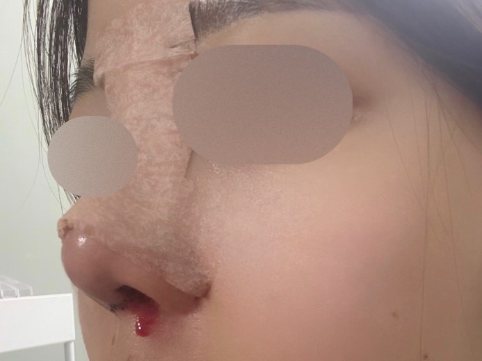 after photo: 콧대(보형물), 코끝(자가연골), 복코교정(수술)