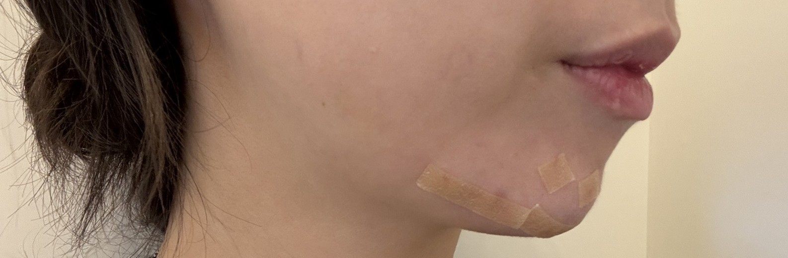 after photo: 턱필러