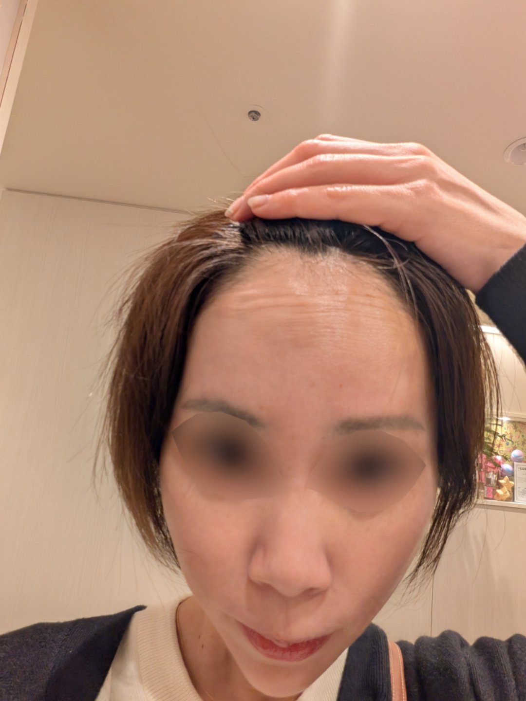 目尻・目の下ボトックス注射｜ボツリヌストキシン注射（1部位）｜目尻のシワ｜1カ月保証 | 横浜TAクリニック, image size:1080x1440